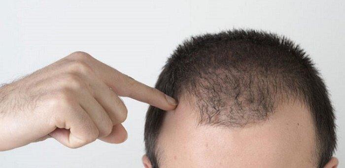 درباره بیوتین؛ ویتامینی موثر در رشد موی مردان