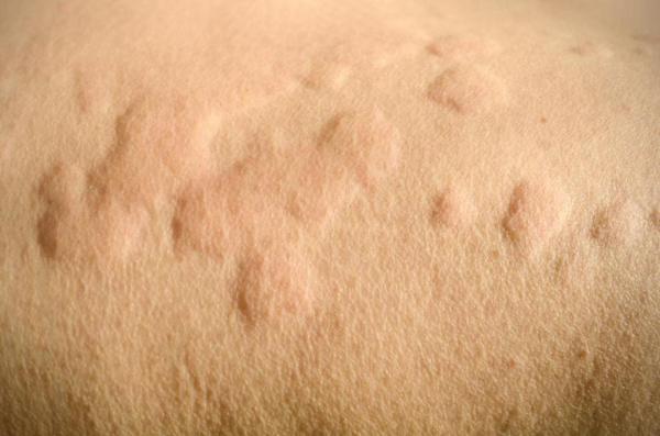 برجستگی های روی پوست نشانه چیست؟